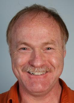 Before Hair Transplant&nbsp;2 Sessions (Areas)